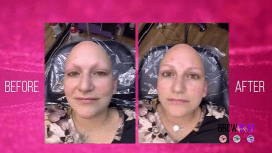 Microblading_For_Alopecia