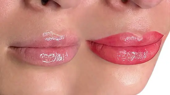 lipwithfillers