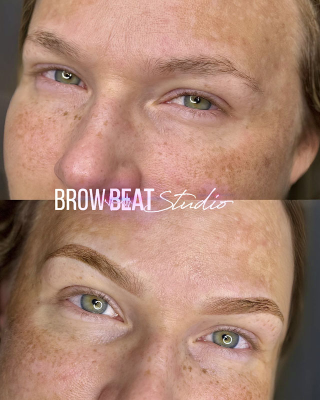 Symmetry refined during brow healing process